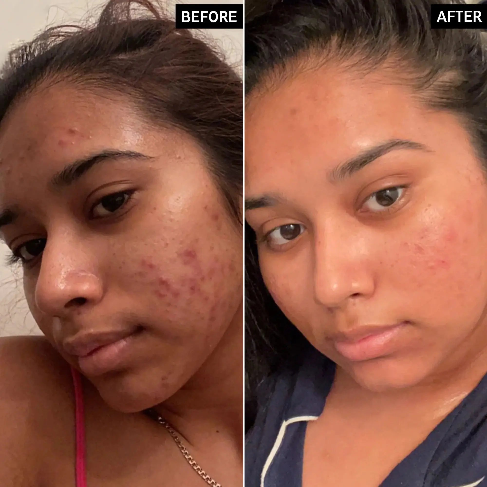 Side-by-side before and after images of a woman with acne-prone skin, highlighting the visible improvement after using The Inkey List 15% Vitamin C and EGF Serum.