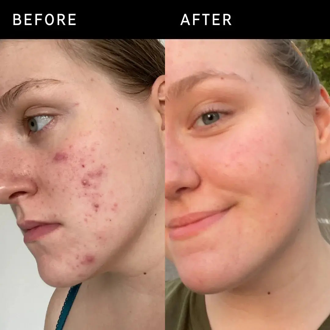 Before and after comparison of a woman using The Inkey List 15% Vitamin C and EGF Serum, showing reduced acne scars and improved skin texture.
