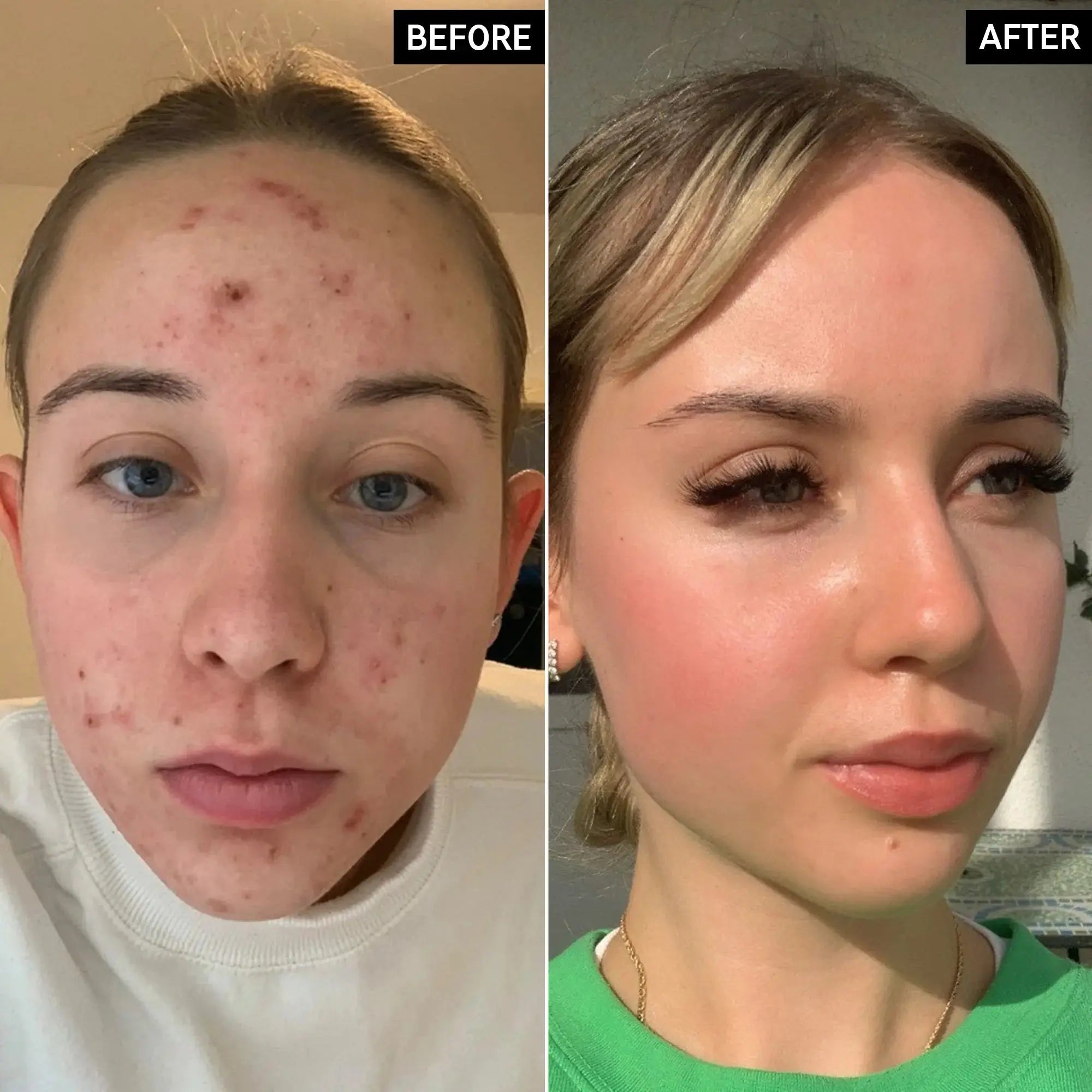Before and after results of The Inkey List Tranexamic Acid Serum, showing significant improvement in acne scars and skin brightness.