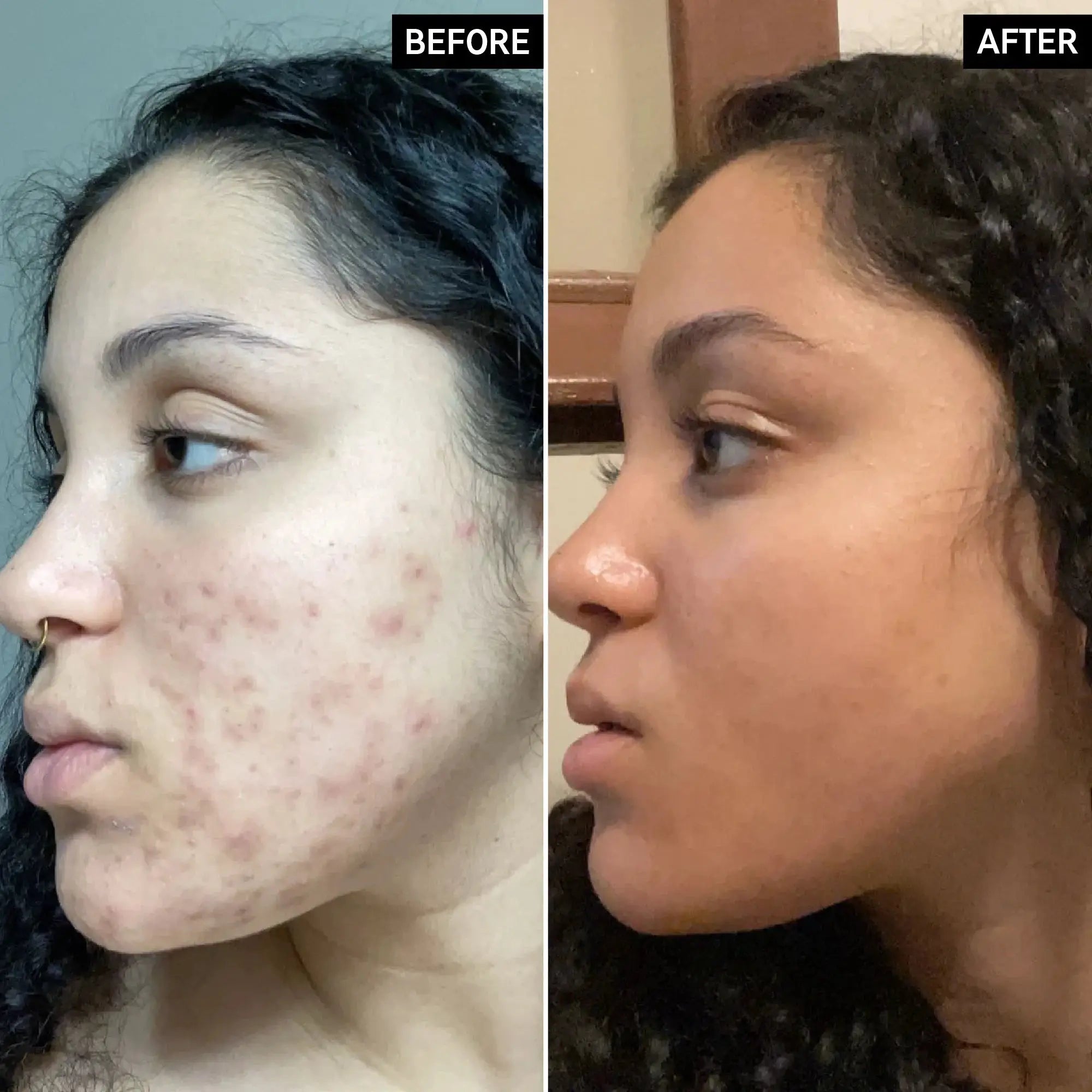 Side-by-side before and after images demonstrating the effectiveness of The Inkey List Tranexamic Acid Serum in reducing hyperpigmentation.