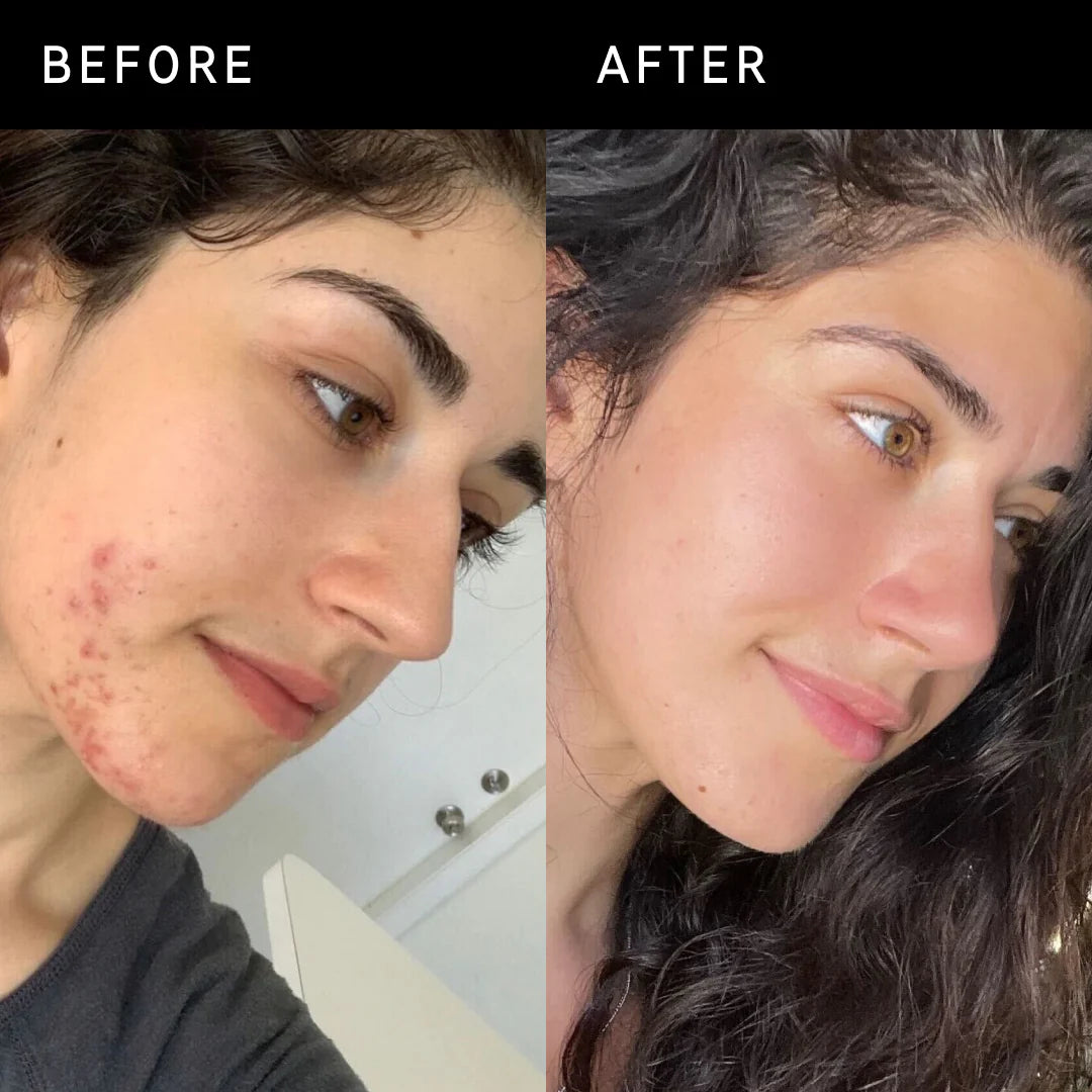 Before and after using Inkey List Succinic Acid Treatment showing visible acne reduction and clearer skin on a woman's face.