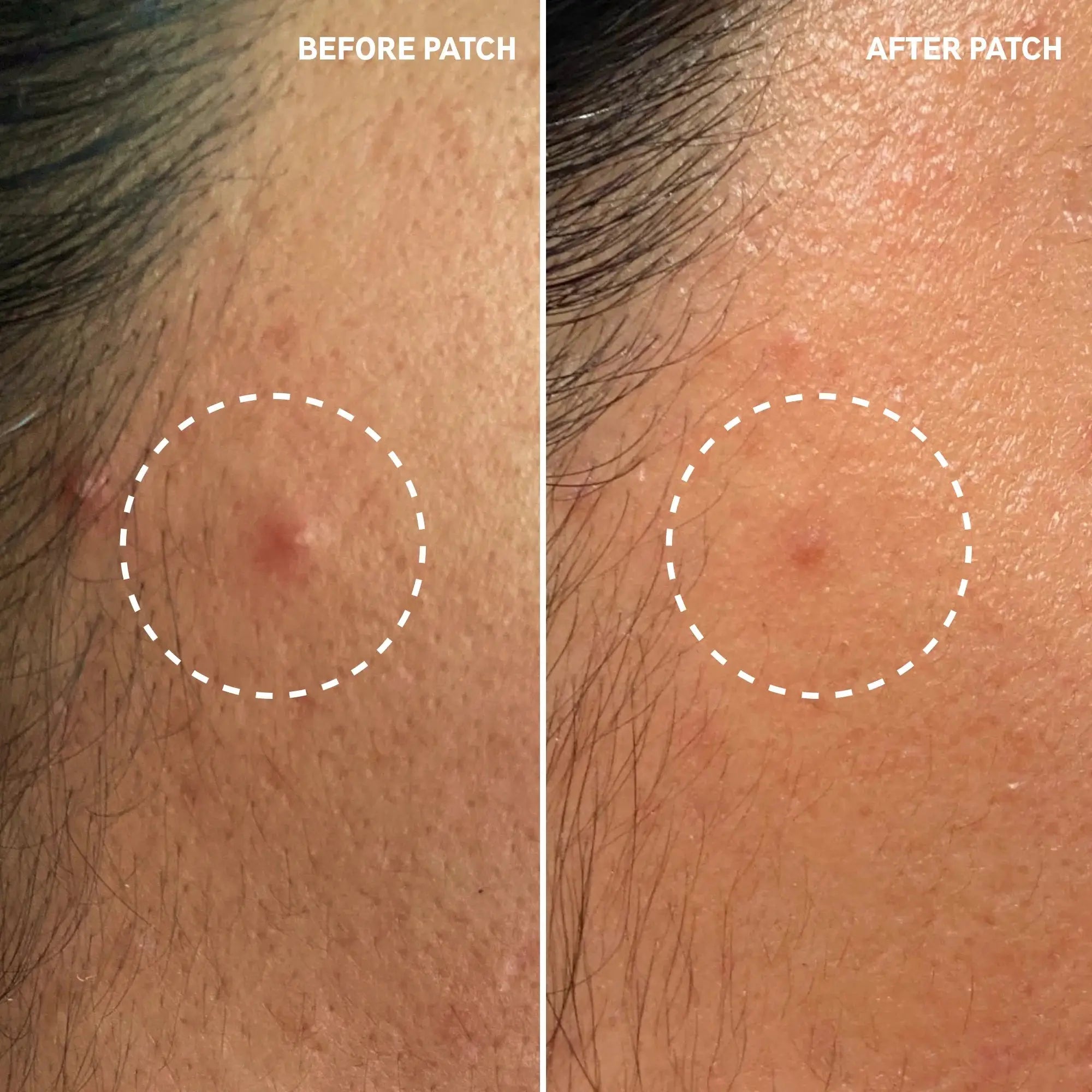 Close-up before and after images of a forehead blemish treated with The Inkey List Hydrocolloid Invisible Pimple Patch, showing clearer skin.