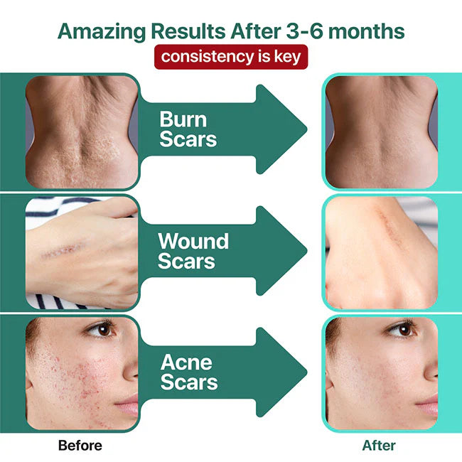 Before and after results of Ebanel Scar Master on burn, wound, and acne scars after 3-6 months of consistent use.