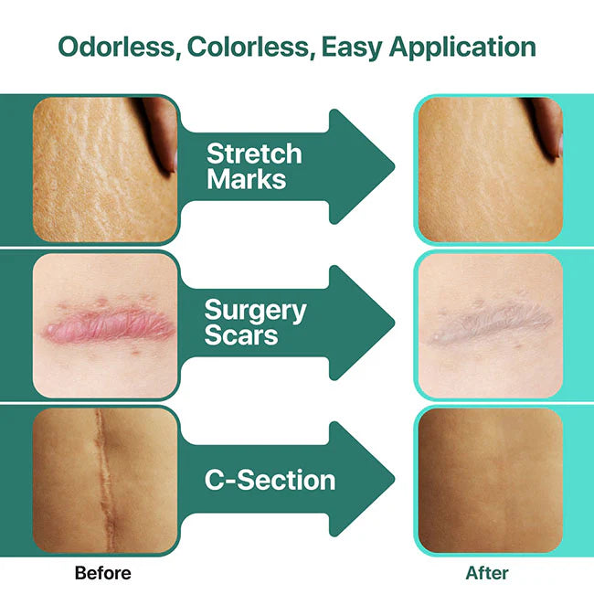 Ebanel Scar Master shows visible improvement on stretch marks, surgery scars, and C-section scars with odorless, colorless application.