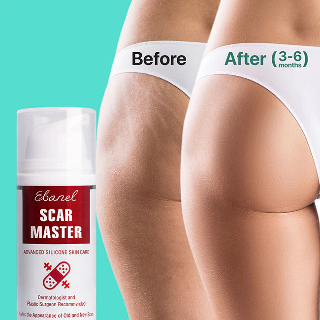 Ebanel Scar Master before and after results on hip area scars after 3-6 months, demonstrating smoother, clearer skin.