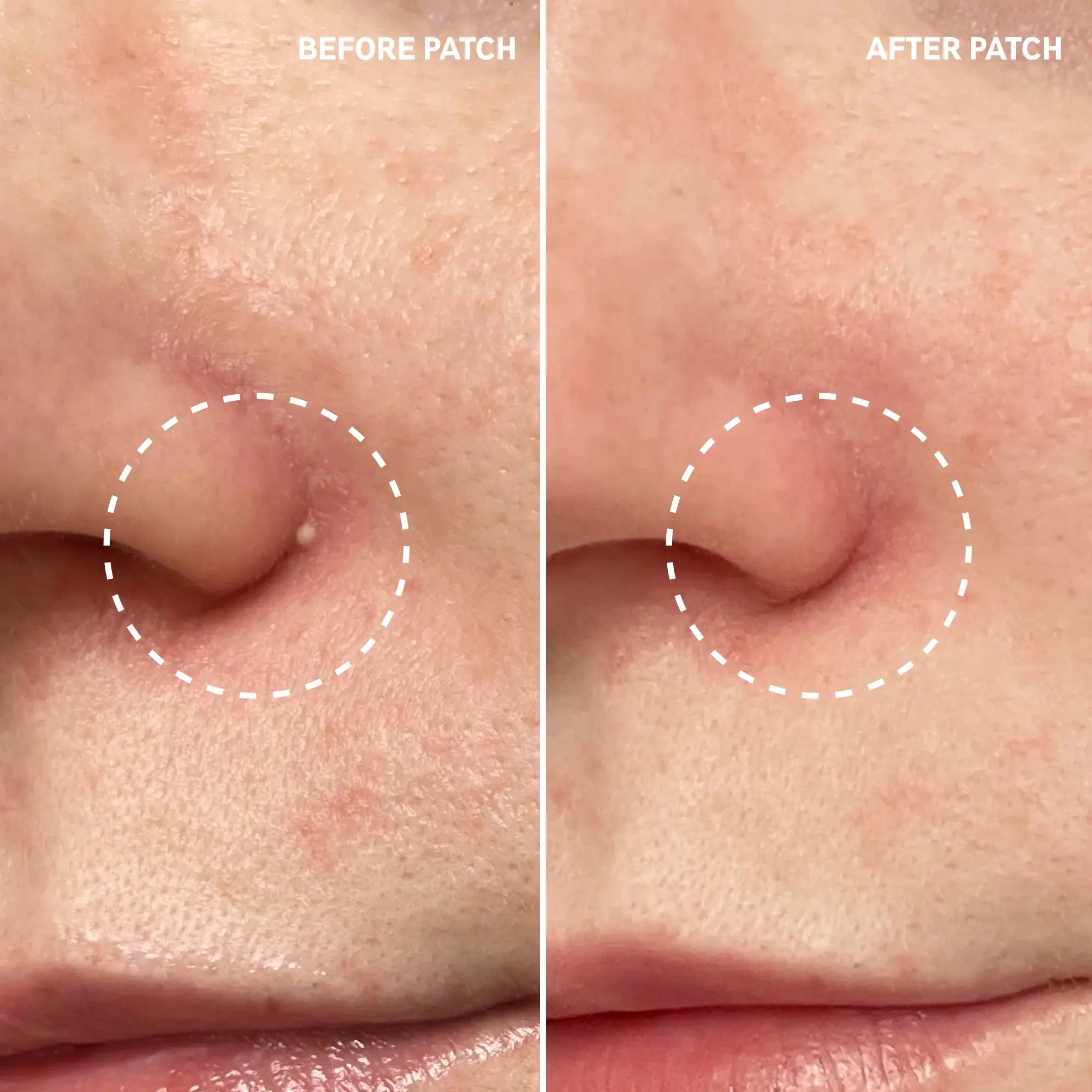 Before and after comparison of a pimple treated with The Inkey List Hydrocolloid Invisible Pimple Patch, showing visible reduction in blemish.