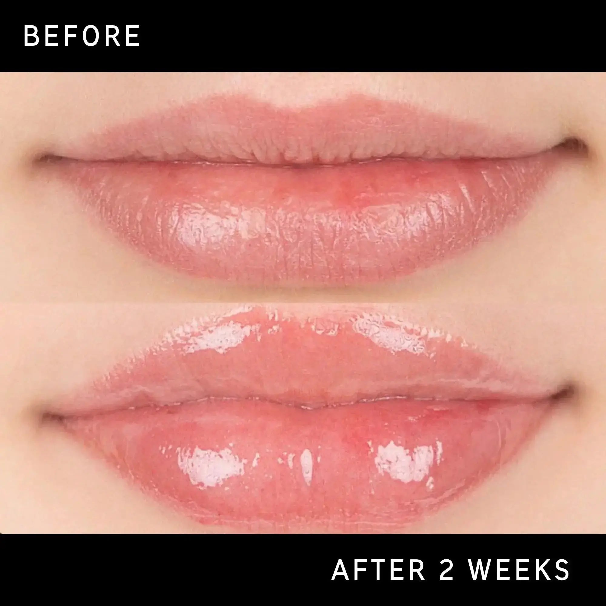 Before and after 2 weeks of using The Inkey List Tripeptide Plumping Lip Balm Pink Tint. Visible improvement in lip fullness and hydration.