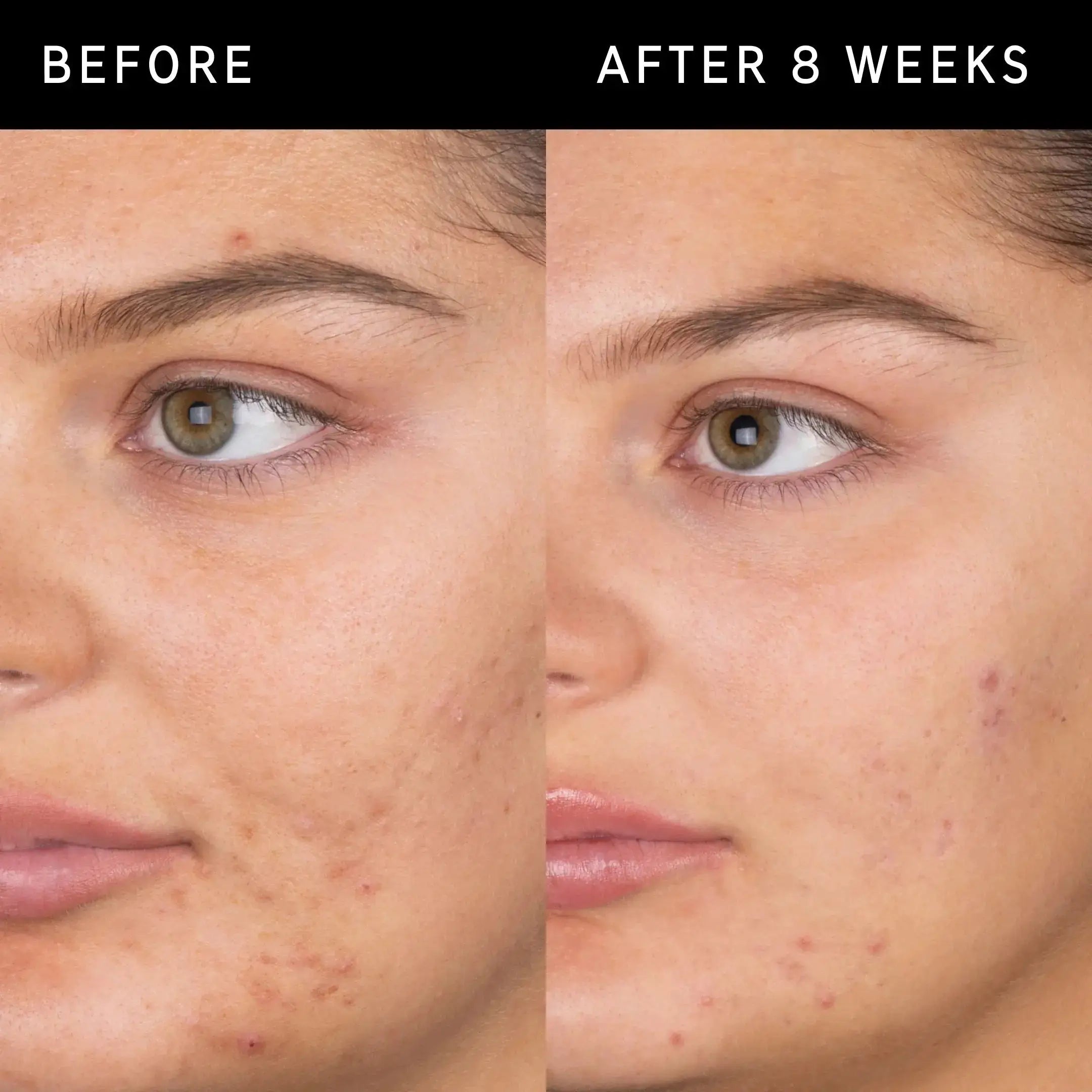 Before and after 8 weeks of using The Inkey List Salicylic Acid Cleanser, showing reduced blemishes and clearer skin.